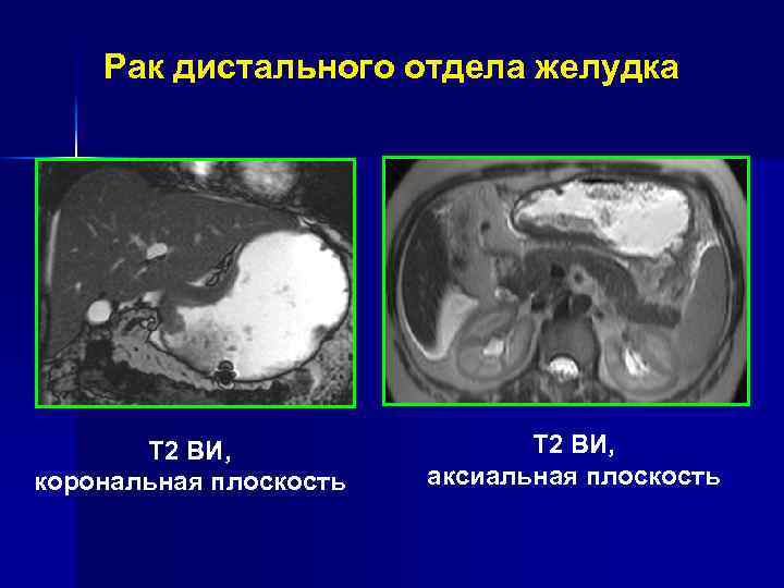 МРТ в стадировании рака желудка Т 1 -Т 2 Т 4 Т 3 