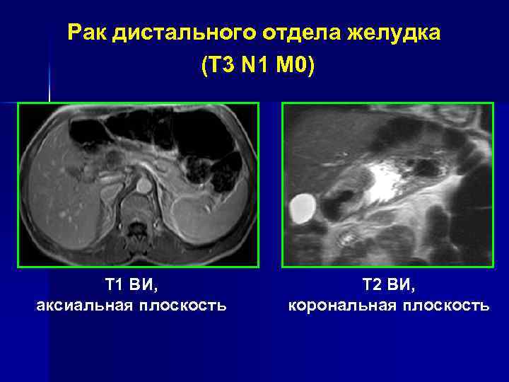 Рак тела желудка (T 4 N 2 M 1) Т 2 ВИ, корональная плоскость