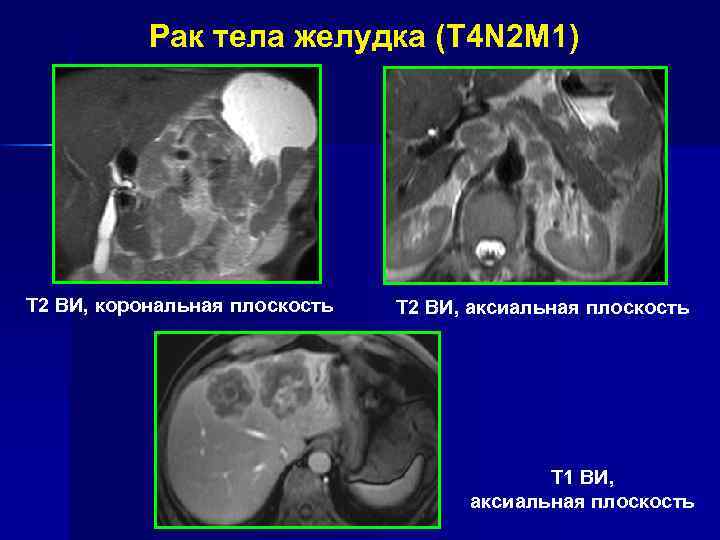 Классификация заболеваний селезенки n Спленомегалия n Кисты селезенки n Абсцессы селезенки n Гемангиомы селезенки