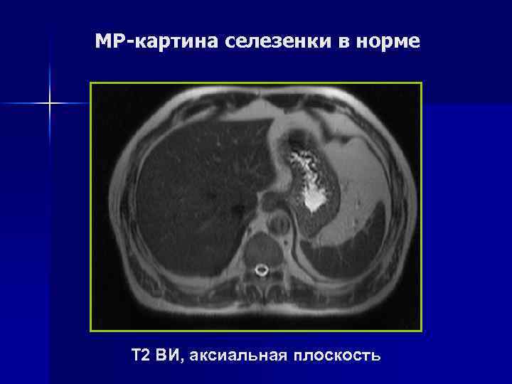 Кт картина спленомегалии