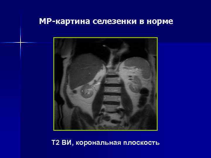 Спленомегалия Т 1 ВИ, аксиальная плоскость 
