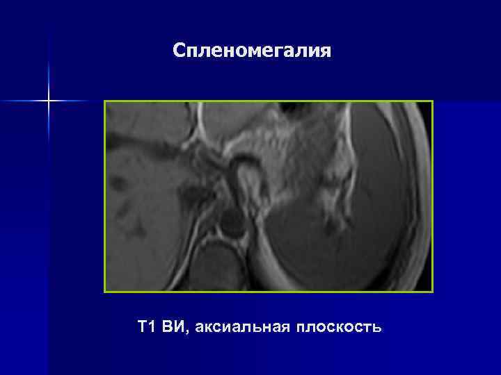 Спленомегалия Т 2 ВИ, аксиальная плоскость 
