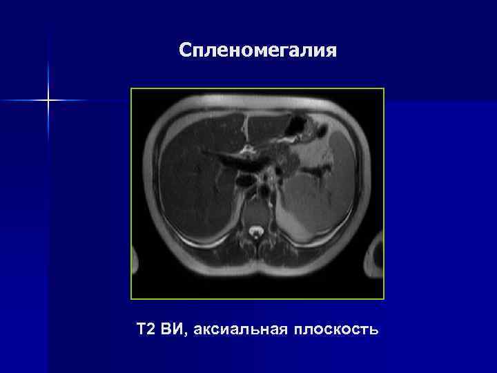 Киста селезенки Т 1 ВИ, аксиальная плоскость Т 2 ВИ, корональная плоскость 