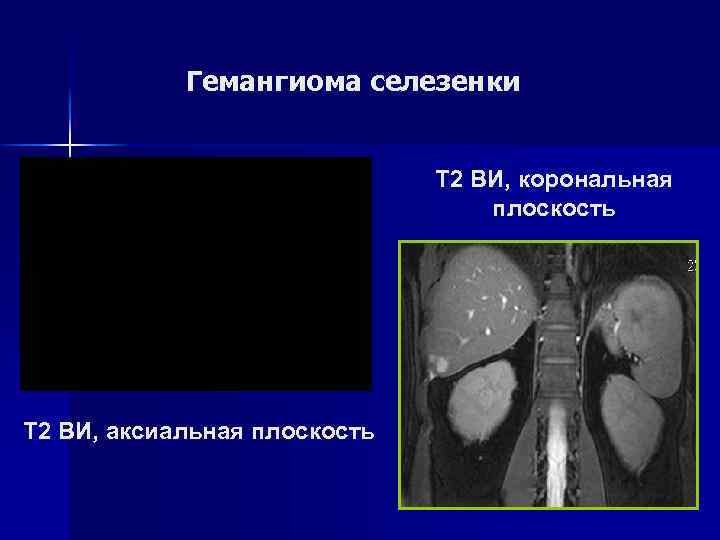 Гемангиома селезенки Т 1 ВИ, аксиальная плоскость 