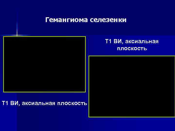 Гемангиома селезенки Т 2 ВИ, корональная плоскость Т 2 ВИ, аксиальная плоскость 