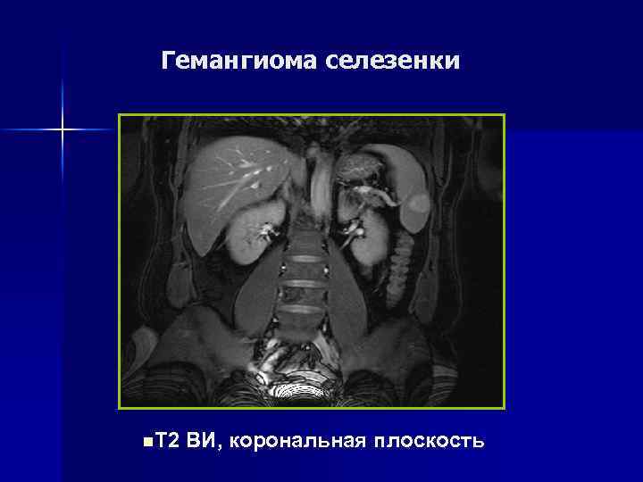 Аномалия развития селезенки Т 2 ВИ, корональная плоскость 