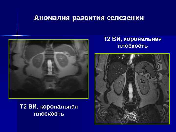 Аномалия развития селезенки Т 2 ВИ, аксиальная плоскость Т 2 ВИ, корональная плоскость 
