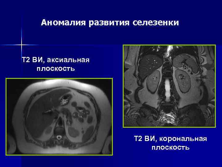 Абсцесс селезенки Т 2 ВИ, корональная плоскость Т 1 ВИ, аксиальная плоскость 
