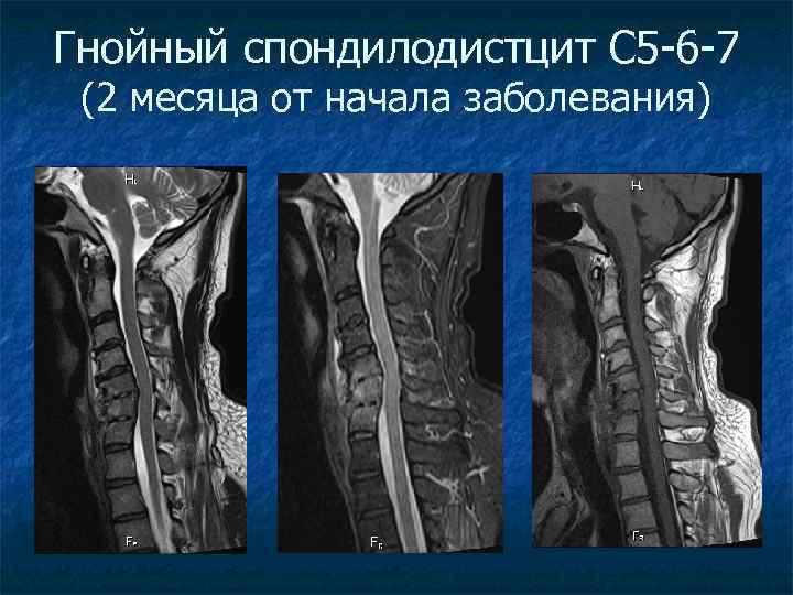 Гнойный спондилодистцит С 5 -6 -7 (2 месяца от начала заболевания) 