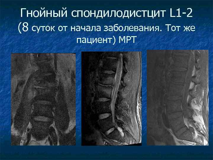 Гнойный спондилодистцит L 1 -2 (8 суток от начала заболевания. Тот же пациент) МРТ