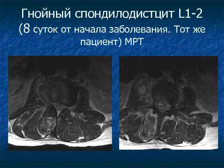 Гнойный спондилодистцит L 1 -2 (8 суток от начала заболевания. Тот же пациент) МРТ