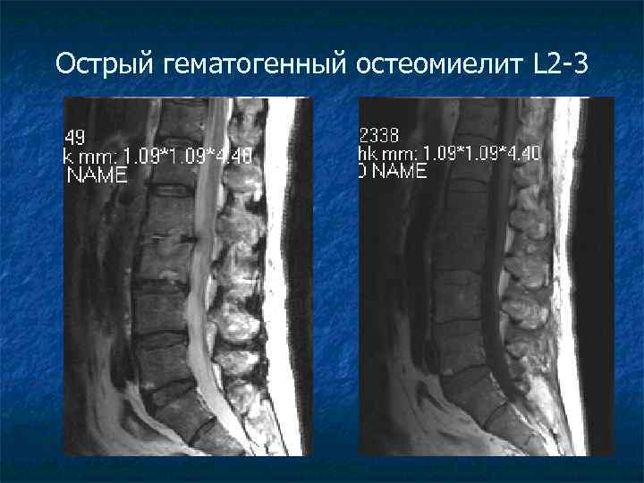 Острый гематогенный остеомиелит L 2 -3 