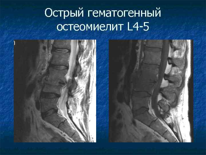 Острый гематогенный остеомиелит L 4 -5 