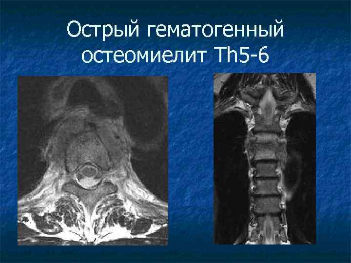 Острый гематогенный остеомиелит Th 5 -6 