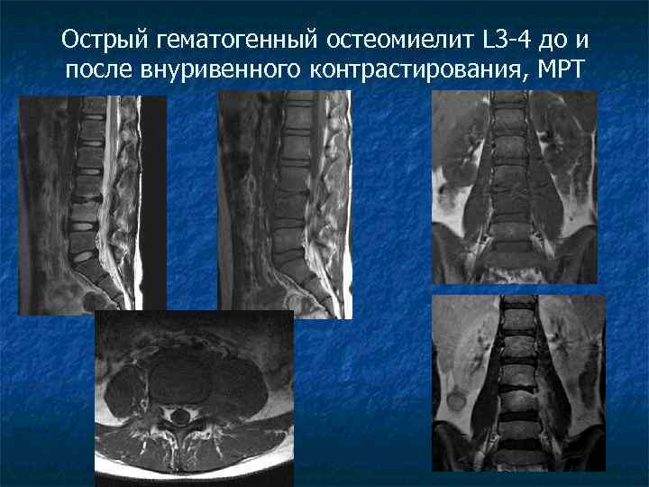 Острый гематогенный остеомиелит L 3 -4 до и после внуривенного контрастирования, МРТ 