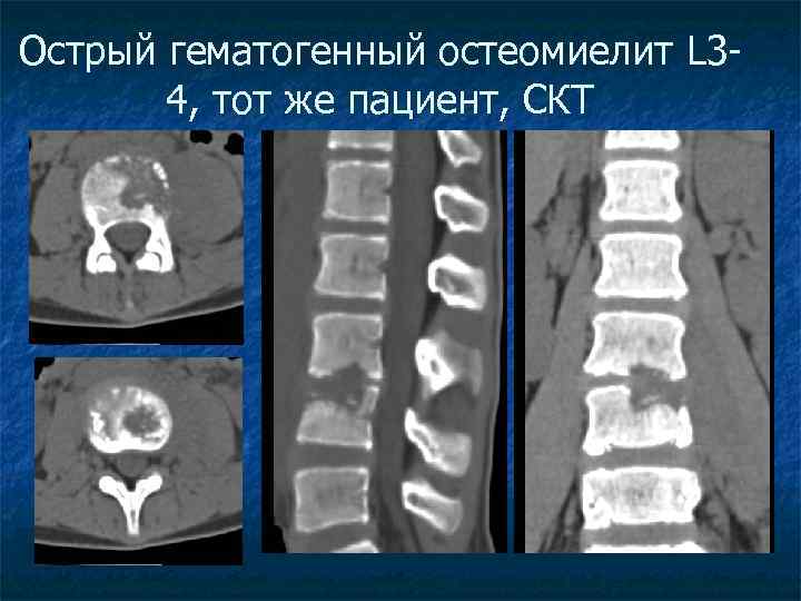 Острый гематогенный остеомиелит L 34, тот же пациент, СКТ 