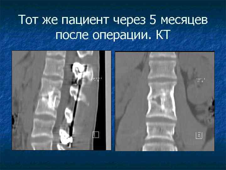 Тот же пациент через 5 месяцев после операции. КТ 