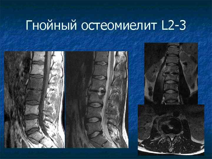 Спондилодисцит мрт картина