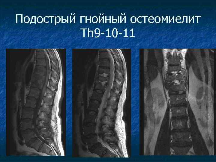 Спондилодисцит мрт картина