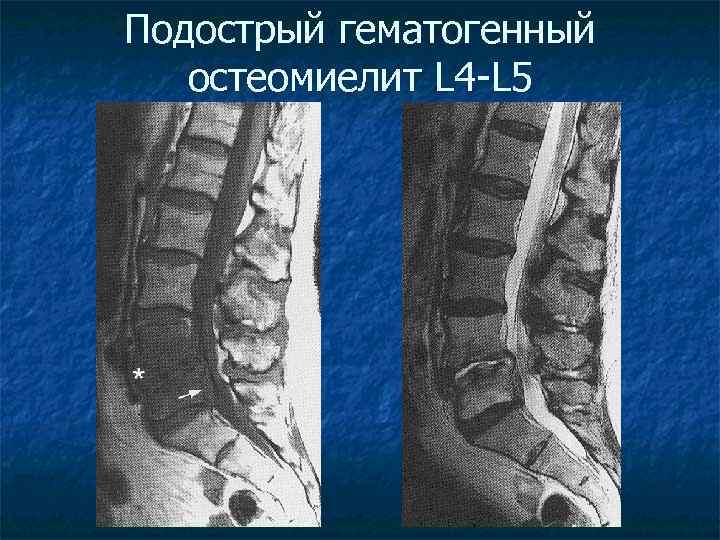 Подострый гематогенный остеомиелит L 4 -L 5 