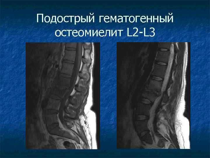 Подострый гематогенный остеомиелит L 2 -L 3 