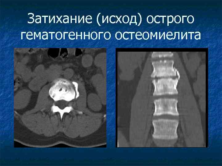 Затихание (исход) острого гематогенного остеомиелита 