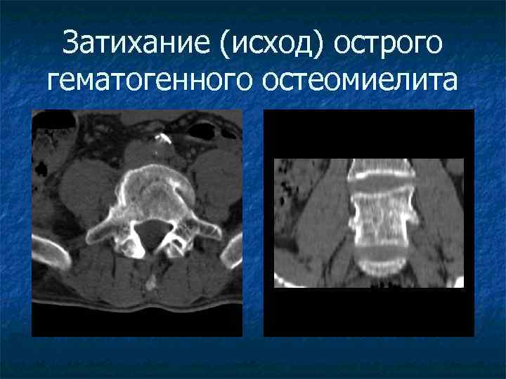 Затихание (исход) острого гематогенного остеомиелита 