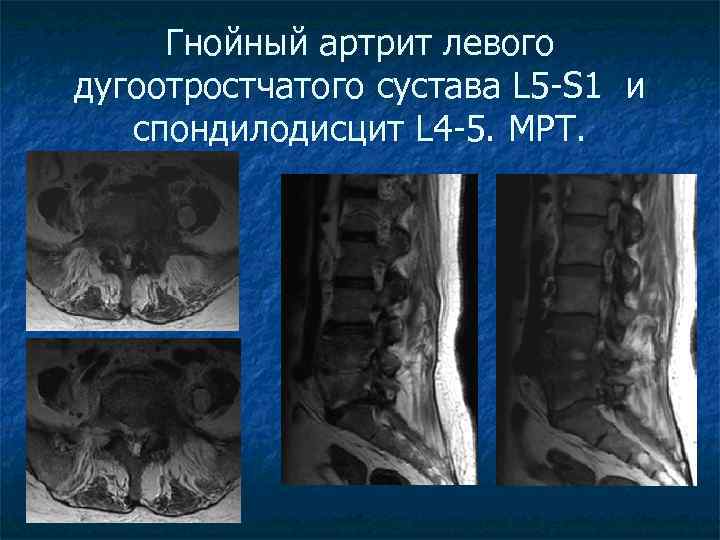 Спондилодисцит мрт картина