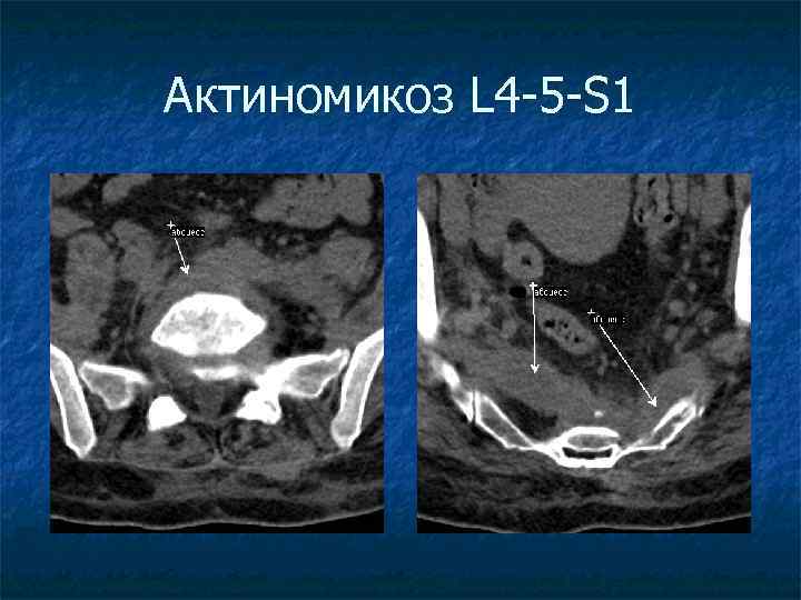 Актиномикоз L 4 -5 -S 1 