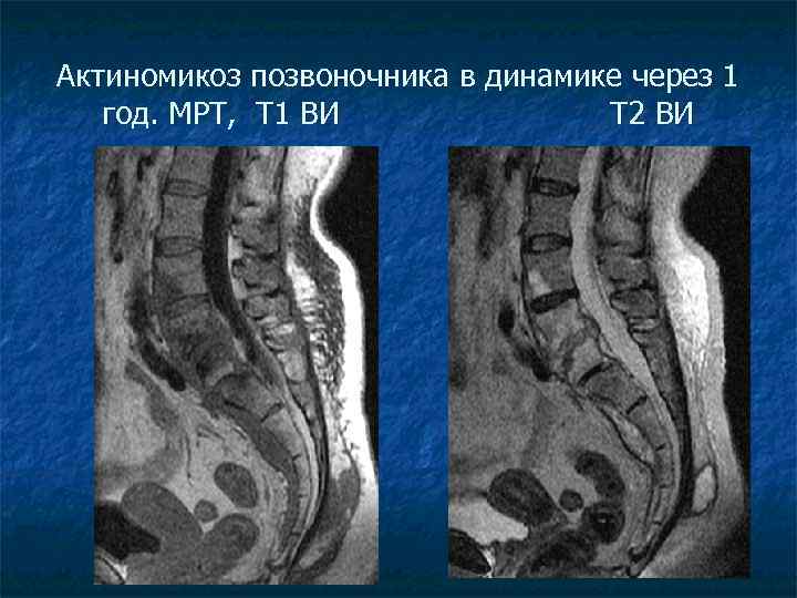 Т2 взвешенное изображение