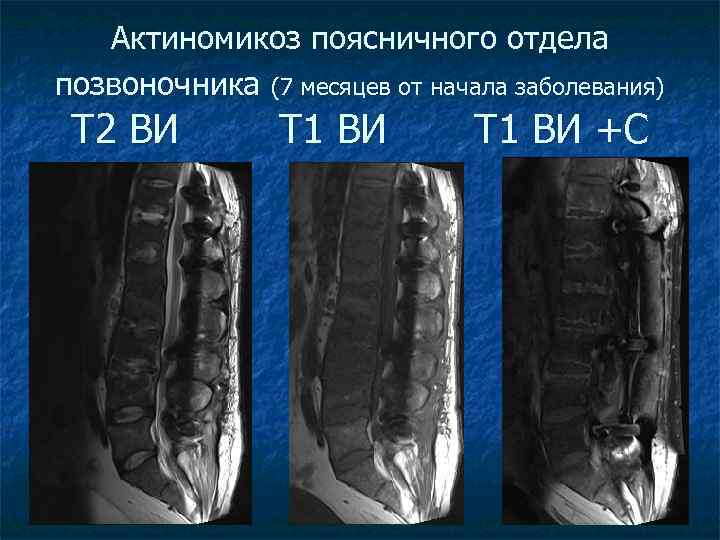 Актиномикоз поясничного отдела позвоночника (7 месяцев от начала заболевания) Т 2 ВИ Т 1