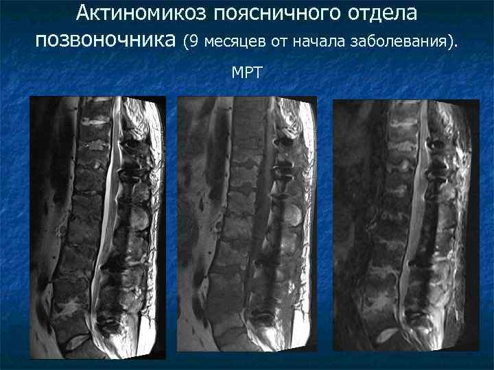 Актиномикоз поясничного отдела позвоночника (9 месяцев от начала заболевания). МРТ 