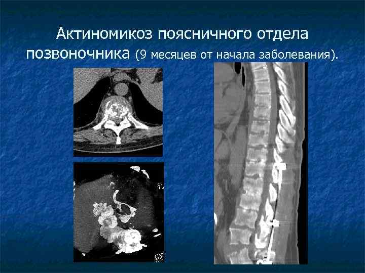 Актиномикоз поясничного отдела позвоночника (9 месяцев от начала заболевания). 