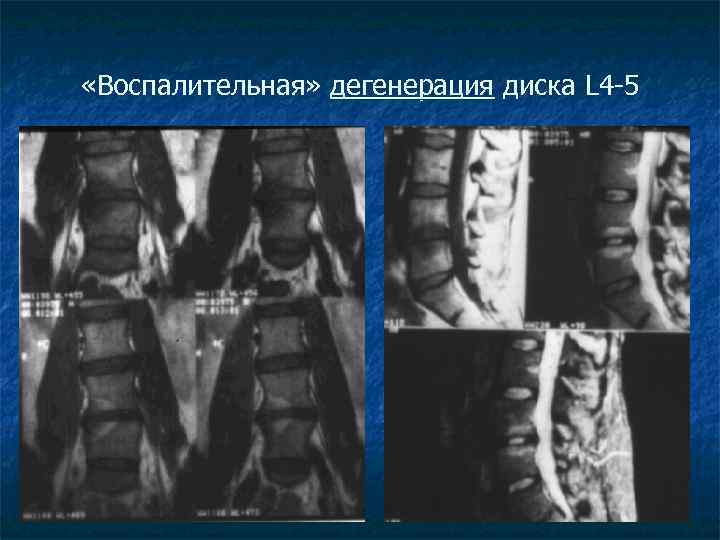  «Воспалительная» дегенерация диска L 4 -5 