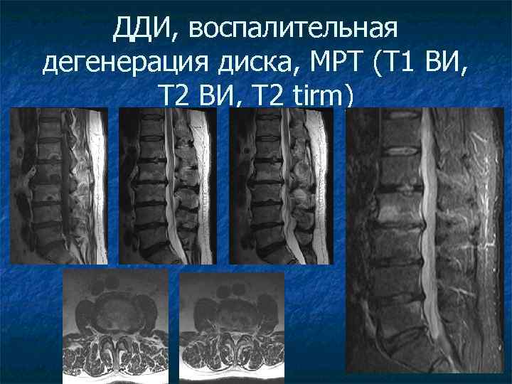 ДДИ, воспалительная дегенерация диска, МРТ (Т 1 ВИ, Т 2 tirm) 