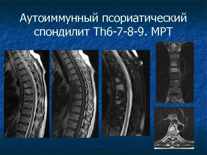 Аутоиммунный псориатический спондилит Th 6 -7 -8 -9. МРТ 