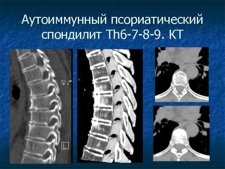 Аутоиммунный псориатический спондилит Th 6 -7 -8 -9. КТ 