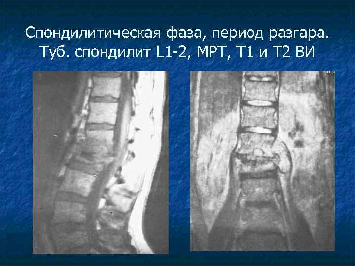 Спондилитическая фаза, период разгара. Туб. спондилит L 1 -2, МРТ, Т 1 и Т