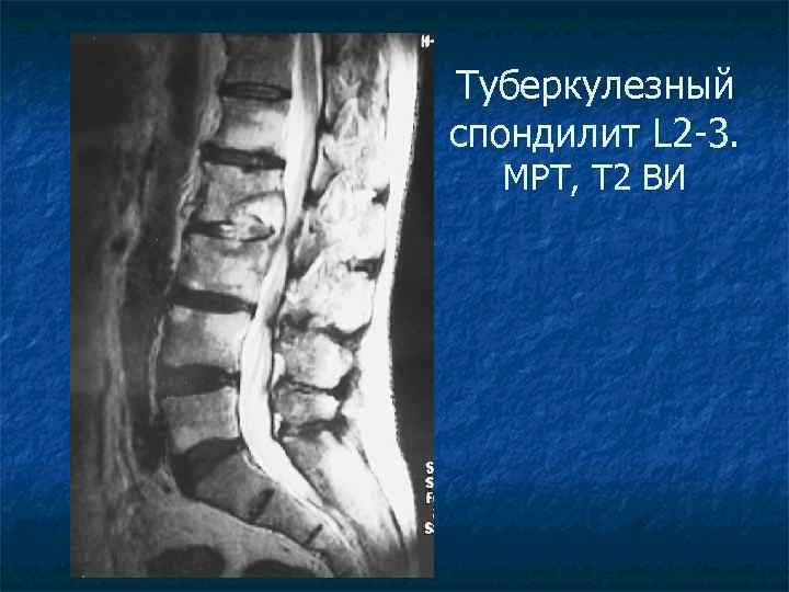 Туберкулезный спондилит L 2 -3. МРТ, Т 2 ВИ 