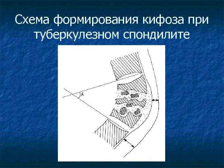 Схема формирования кифоза при туберкулезном спондилите 