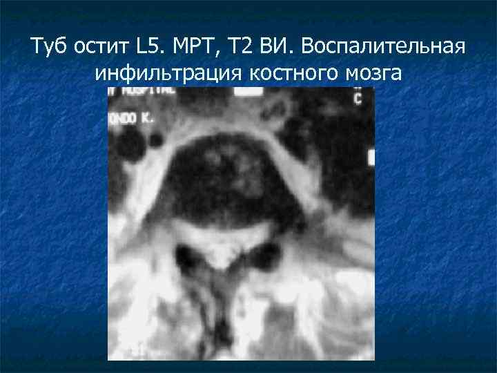 Туб остит L 5. МРТ, Т 2 ВИ. Воспалительная инфильтрация костного мозга 