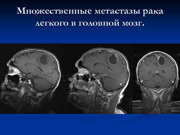 Множественные метастазы рака легкого в головной мозг. 