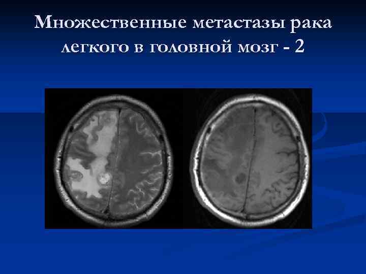 Множественные метастазы рака легкого в головной мозг - 2 
