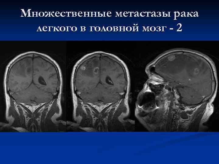 Метастазы в мозг прогноз