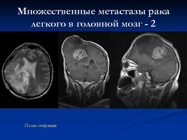 Метастазы в мозгу форум. Множественные метастазы в головной мозг. Метастатические опухоли головного мозга. Опухоль головного мозга метастазы.