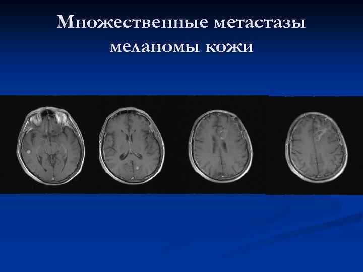 Множественные метастазы меланомы кожи 
