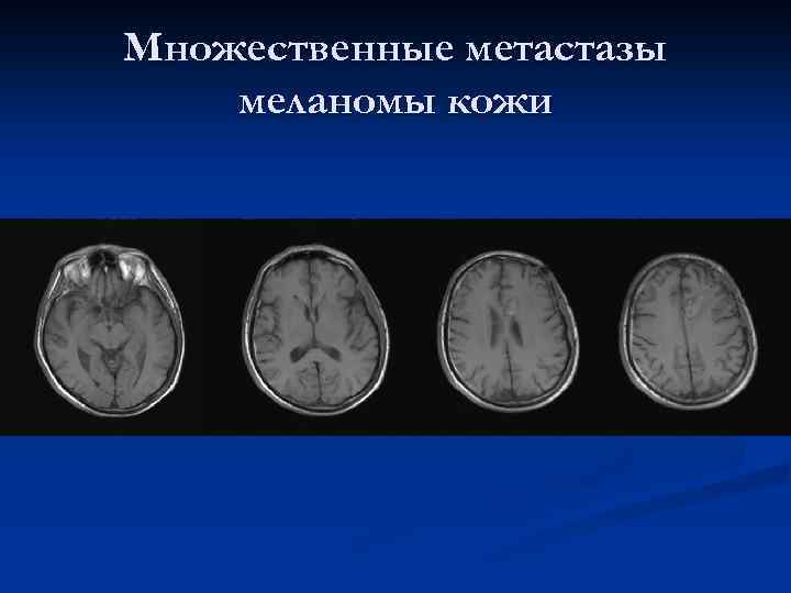 Множественные метастазы меланомы кожи 