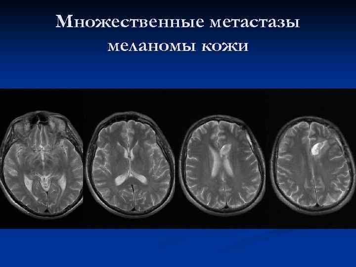 Множественные метастазы меланомы кожи 