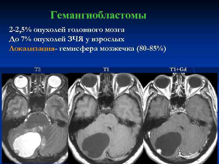 Гемангиобластомы 2 -2, 5% опухолей головного мозга До 7% опухолей ЗЧЯ у взрослых Локализация-