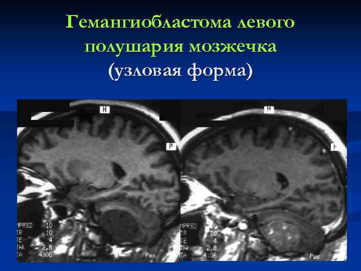 Гемангиобластома левого полушария мозжечка (узловая форма) 